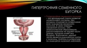 Киста семенного бугорка предстательной железы