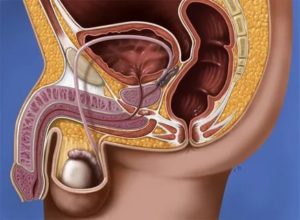 Можно ли при хроническом простатите заниматься оральным сексом