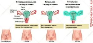 Сколько могут длиться выделения после операции по удалению матки