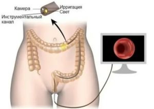 Можно ли колоноскопию делать при месячных с тампоном