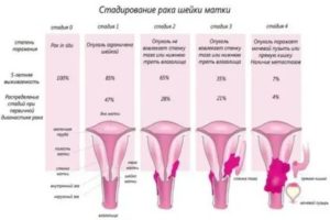 Как предохраняться после операции рак шейки матки