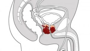 Ночное семяизвержение простатита