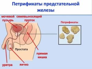 Конкременты в предстательной железе что это такое