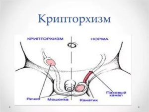 Когда опускаются яички у мальчиков узи