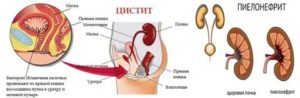 Как определить молочница у тебя или цистит