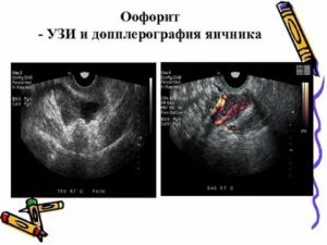 Хронический двухсторонний оофорит на узи