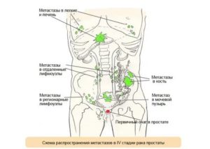 Метастазы в почки при раке предстательной железы