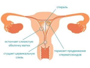 Можно ли ставить внутриматочную спираль при эндометриозе