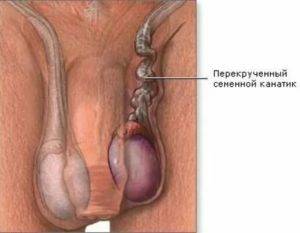 Может ли быть перекрут яичка если уже была такая операция
