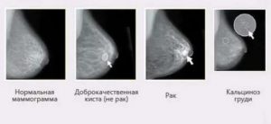 Может ли маммография показать кисты молочной железы