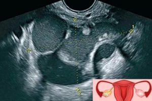 Может ли узи определить злокачественную опухоль яичника