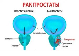 Ромашка против рака простаты