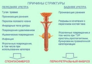 Как образуется стриктура уретры после тур простаты