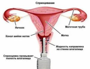 Как правильно делать спринцевание в домашних условиях при молочнице грушей