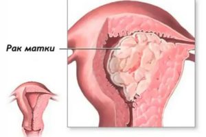 Что такое рак эндометрии и как это проявляется