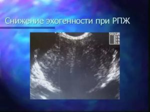 Узи предстательной железы эхогенность снижена
