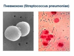 Простата диплококки внеклеточно что это такое