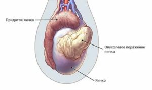 Рак придатка яичка симптомы у женщин