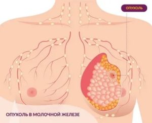 Чертополох при раке молочной железы