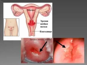 Что такое эрозия шейки матки и может она перейти в рак