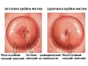 Когда можно планировать беременность после удаления кисты шейки матки