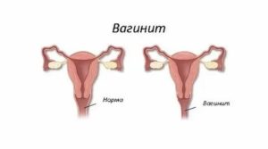 Может ли повышаться температура при вагините