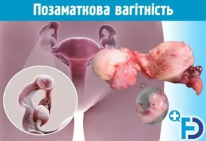Почему иногда месячные проходят болезненно а иногда нет