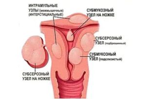 Интерстициальный узел по задней стенке матки при климаксе