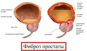 Как лечить фиброз простаты народными средствами