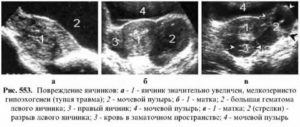 Нечеткие контуры яичника на узи причины