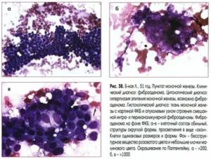 Что такое цитология при раке молочной железы