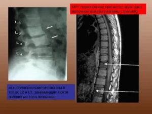 Как лечить метастазы в позвоночнике при раке молочной железы