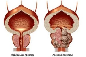 Перегородки грецких орехов при аденоме предстательной железы