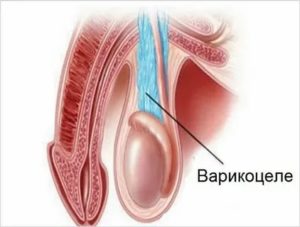 Что за операция у подростка на яичках