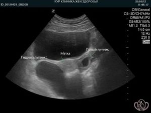 Расширенная маточная труба на узи
