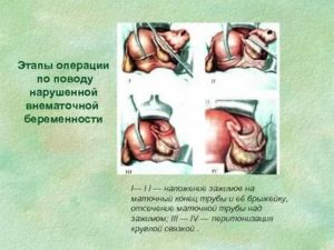 Сколько дней больничного при операции по внематочной беременности