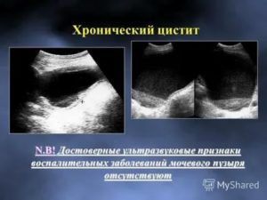 Можно ли выявить цистит по узи