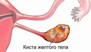 Как понять что фолликулярная киста рассосалась во время месячных