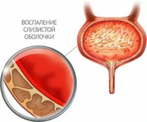 Что такое гнойный цистит и как его лечить