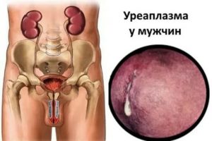 Почему нельзя заниматься сексом во время лечения от уреаплазмоза