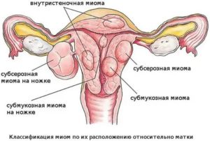 Миома матки этиология классификация клиника диагностика лечение