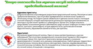 Как и сколько пить воду при аденома предстательной железы