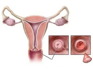 Почему после конизации шейки матки долго идут месячные что