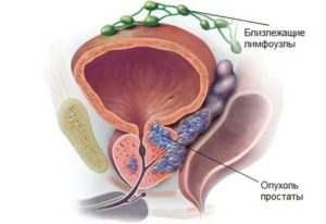 Может ли аденома простаты перерасти в злокачественную опухоль
