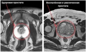 Мрт-признаки гиперплазии предстательной железы