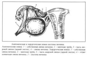 Хирургическая ножка опухоли яичника включает в себя