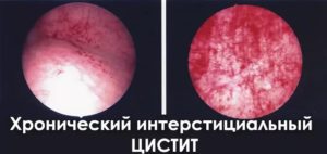 Когда при цистите делают цистоскопию