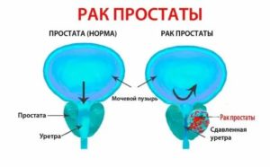 Пиво вызывает рак простаты или нет