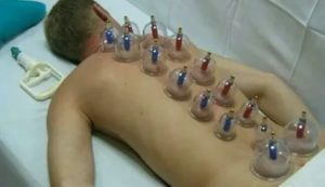 Вакуумные банки на простату