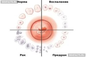 Может ли эрозия шейки матки перерасти в рак отзывы